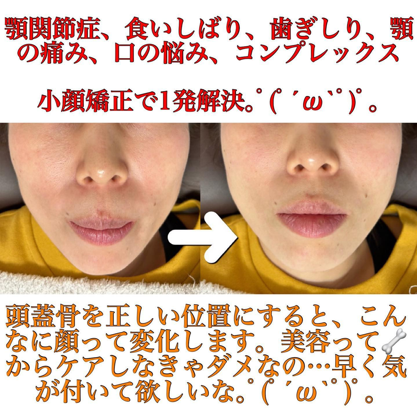 小顔矯正で顔の歪みを改善すれば顎関節症、食いしばり、顎の痛み、見た目のコンプレックス全て改善されます。 | ブログ
